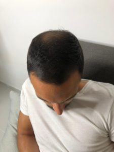 Tretmani protiv opadanja kose - prp kose rezultaati/iskustva - ordinacija rejuva Beograd