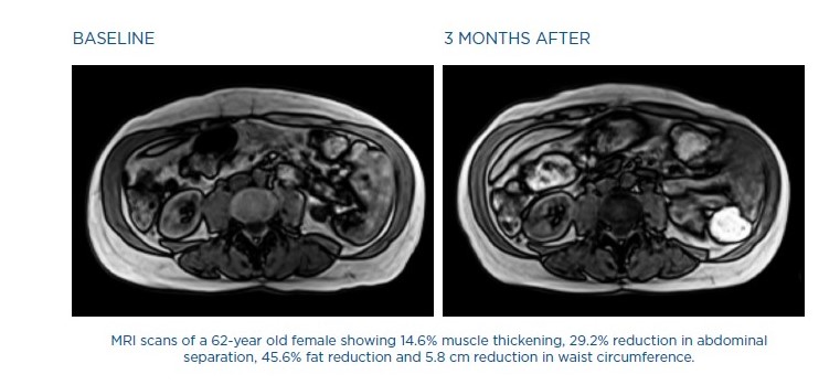 MRI snimak pre i posle EmSculpt NEO tretmana dijastaze stomaka kod žene od 62 godine – povećanje mišićne mase, smanjenje masnog tkiva i sužavanje stomaka.