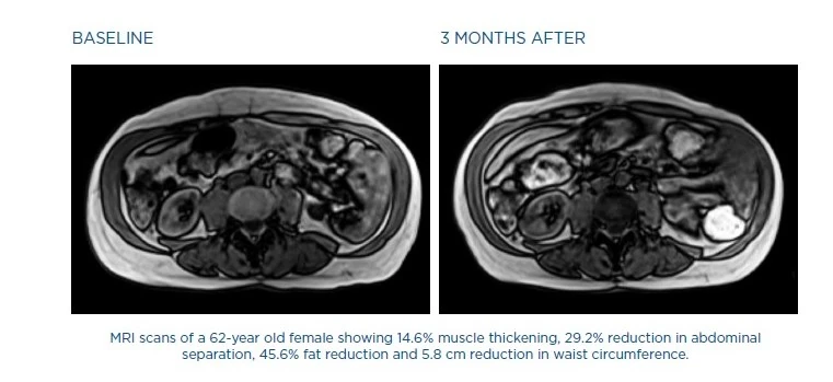 MRI snimak pre i posle EmSculpt NEO tretmana dijastaze stomaka kod žene od 62 godine – povećanje mišićne mase, smanjenje masnog tkiva i sužavanje stomaka.